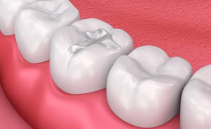 Dental Fillings
